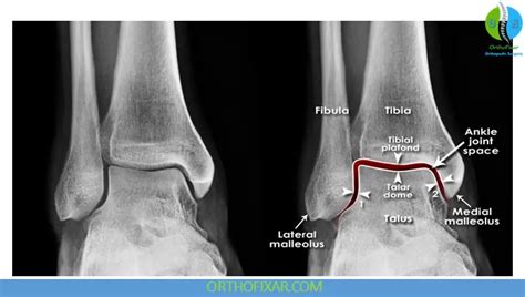 ankle  ray imaging views indications  syndesmosis criteria