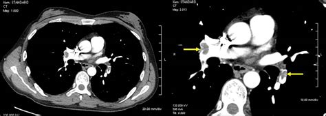 Pulmonary Embolism Diagnosis ~ Akufisio Blogspot