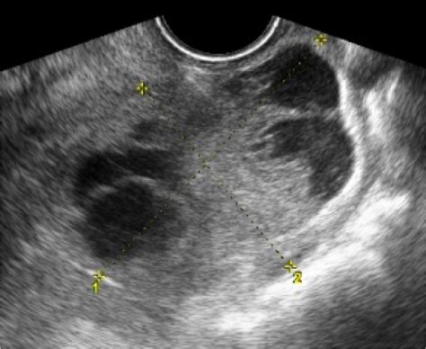 Simple Descriptors And Simple Rules Of The International Ovarian Tumor