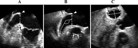 Analysis of the Left Atrial Appendage by Three-Dimensional ...