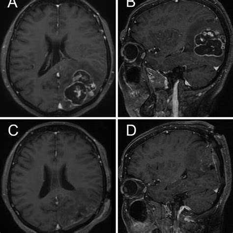 Preoperative Axial A And Sagittal B T1 Weighted Mri Analyses After