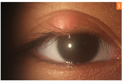 Inclusion Cysts Eyelid