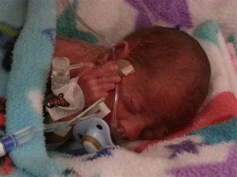 Born At 22 Weeks Tiny 1lb 3oz Babys Amazing Story