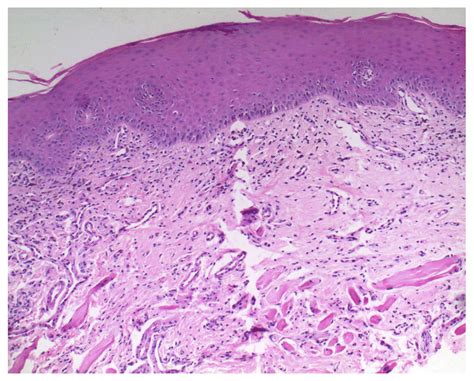 Oral Lichen Planus Histology