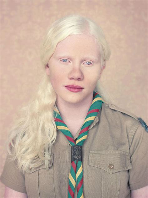 Diagnosis & Tests - Albinism