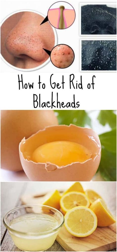 Awesome Homemade Blackheads Removers That Are Easy To Make All For