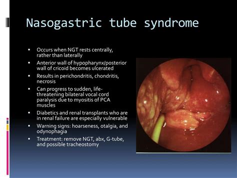 Ppt Laryngeal Complications Of Endotracheal Intubation Powerpoint