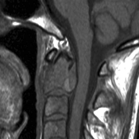 Percutaneous Intervention Of The C2 Vertebral Body Using A CT Guided