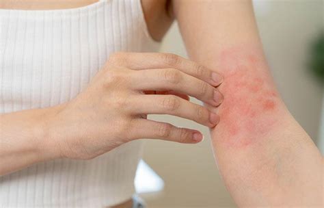 Hiv Skin Rashes Symptoms Causes And Treatment Options