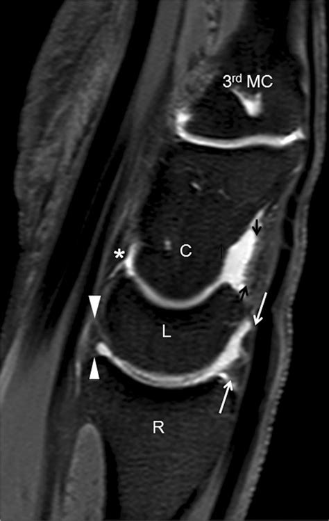 Normal T1 Weighted Fat Suppressed Sagittal Mr Arthrography Of The Wrist