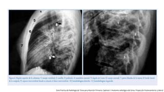 Interpretaci N De Radiograf A De T Rax Ppt