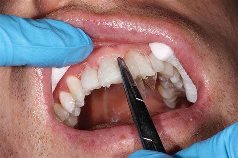 Soll Fig 15a Oral Health Group