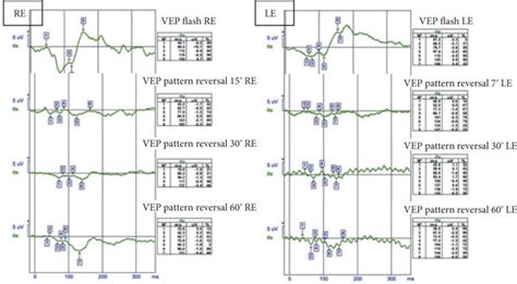 Visual Evoked Potentials Comparative Visual Evoked Potentials Of The