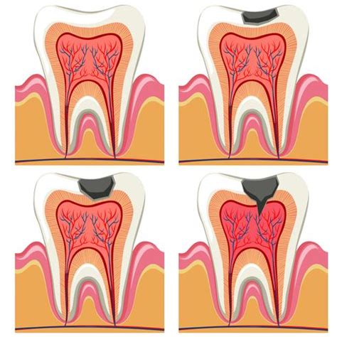 Tooth decay diagram in details 430932 Vector Art at Vecteezy