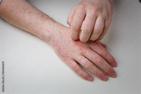 Foto De Finger Scratching Hands With Allergic Red Rash Derma Disease With Painful Itchy Sores