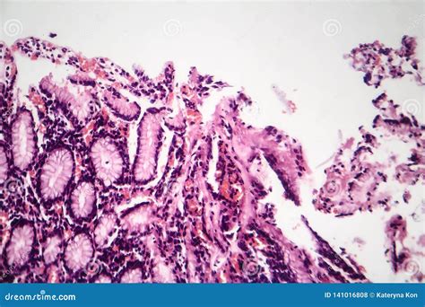 Chronic Atrophic Gastritis Light Micrograph Stock Photo Image Of