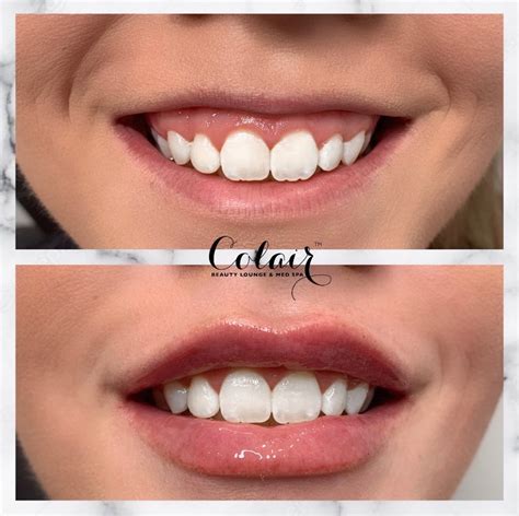 Treating Gummy Smile With Botox Colair Beauty Lounge