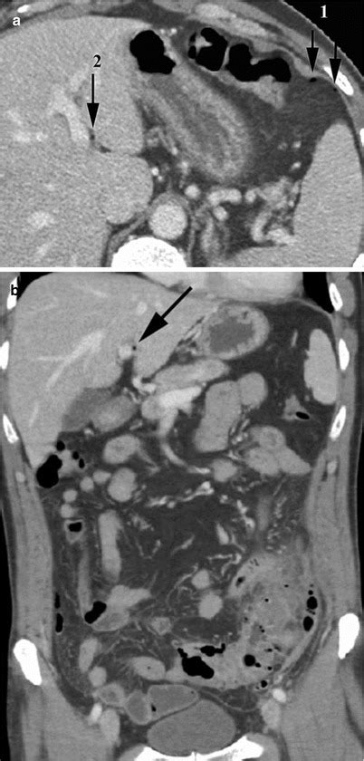 Fig 138 A B Perforated Sigmoid Diverticulitis Diseases Of The Abdomen And Pelvis