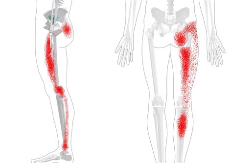 Gluteus Trigger Points