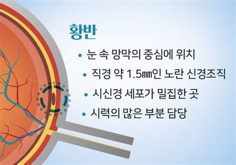 인구 고령화로 급증하는 실명 질환 황반변성