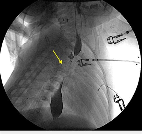 Figure 2 from Rare Case of Double Esophageal Web in a Two-Year-Old ...