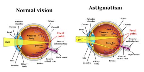 Astigmatism Things You Should Know Ttdeye