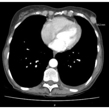 Post-Operative Outcomes of Partial Omentectomy and Complete Omentectomy ...