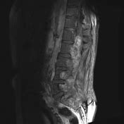 Myxopapillary ependymoma | Radiology Reference Article | Radiopaedia.org