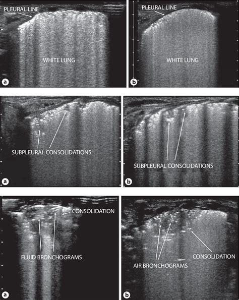 Figure 1 From Lung Ultrasound In Respiratory Distress Syndrome A Useful Tool For Early