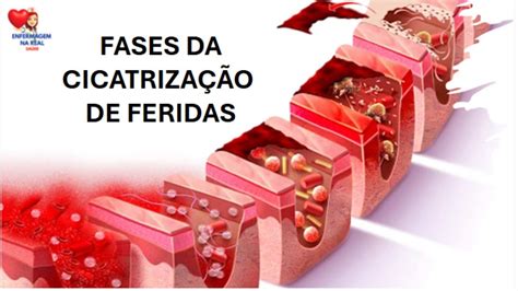 FASES DA CICATRIZAÇÃO DE FERIDAS PROCESSO NATURAL YouTube