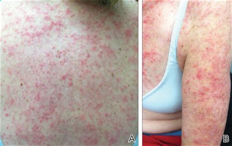 Anastrozole Induced Subacute Cutaneous Lupus Erythematosus MDedge