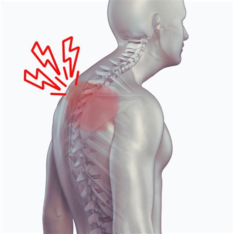 Scheuermann Disease Symptoms Diagnosis And Treatment