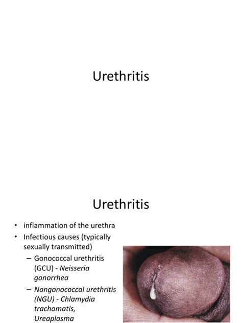 Urethritis | Candidiasis | Rtt