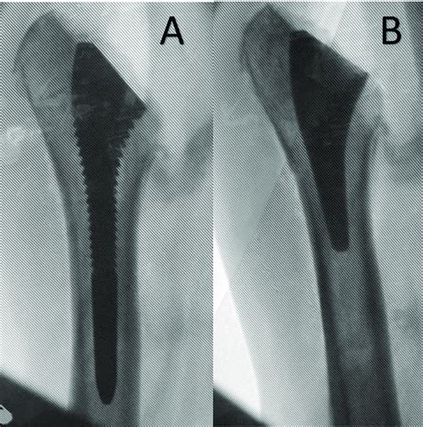 True Anteroposterior Humeral Radiographs Showing Well Aligned Implants