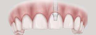 The Dental Implant Guide The Dental Implant Guide