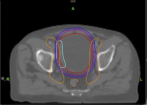 Clinical Outcomes With Dose Escalated Adaptive Radiation Therapy For Urinary Bladder Cancer A