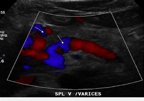 Doppler ultrasound of the liver revealing multiple venous collaterals ...