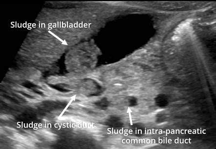 Gallbladder Sludge