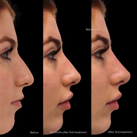 Non Surgical Rhinoplasty Procedures Vancouver One Clinic Md