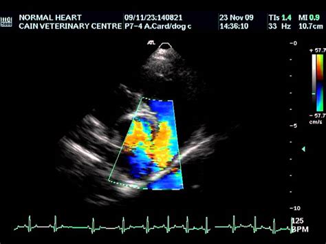 Colour Doppler Echocardiography Youtube