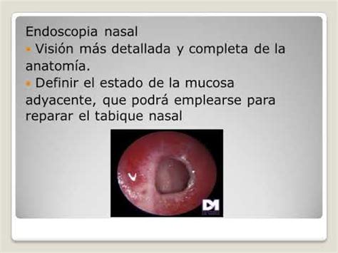 Perforaci N Septal Youtube