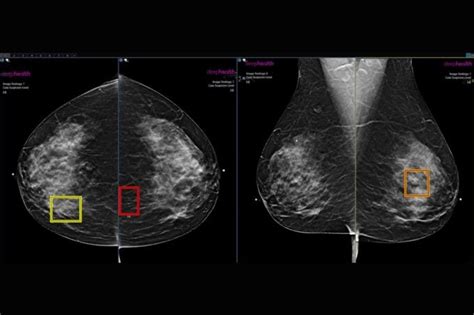 Ai Is Detecting More Breast Cancer Cases Study Suggests