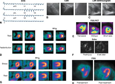 Stunned Myocardium With Characteristic Transient Left Ventricular