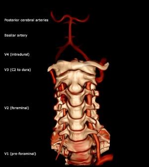 Vertebral Artery - Physiopedia