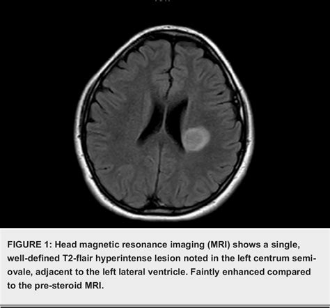 Figure From Neurosarcoidosis Presented As An Isolated Brain Lesion