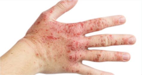 Expert Advice Occupational Skin Disease Hazards Arco Ireland