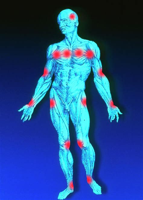 Male Figure Depicting Pain Points In Fibromyalgia Photograph by Alfred ...