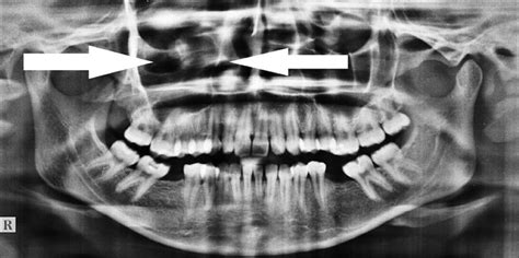 Infected Dentigerous Cyst Of Maxillary Sinus Arising From An Ectopic