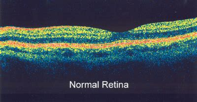 Optical Coherence Tomography | Kadrmas Eye Care NE - Kadrmas Eye Care ...