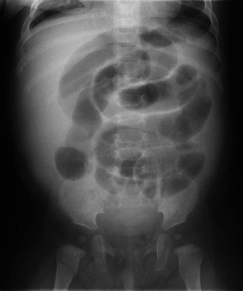 Imaging And Intussusception Adc Education Practice Edition